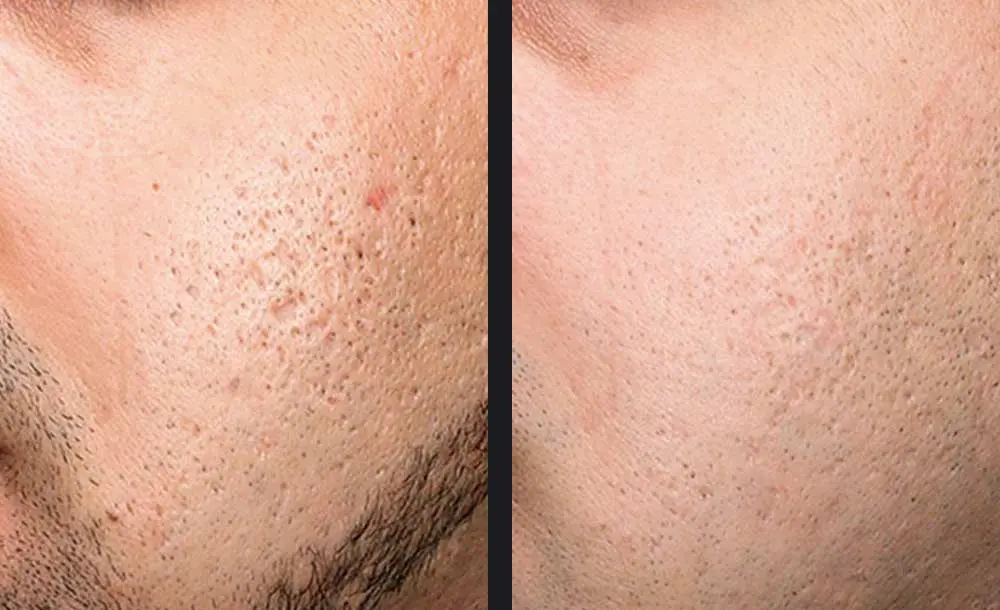 exceed microneedling leeds