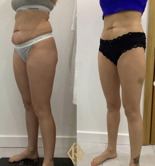 fat freezing offers in Leeds