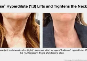 Radiesse®  for Neck & Décolletage – Restore Firmness and Glow at R&R Aesthetics Garforth