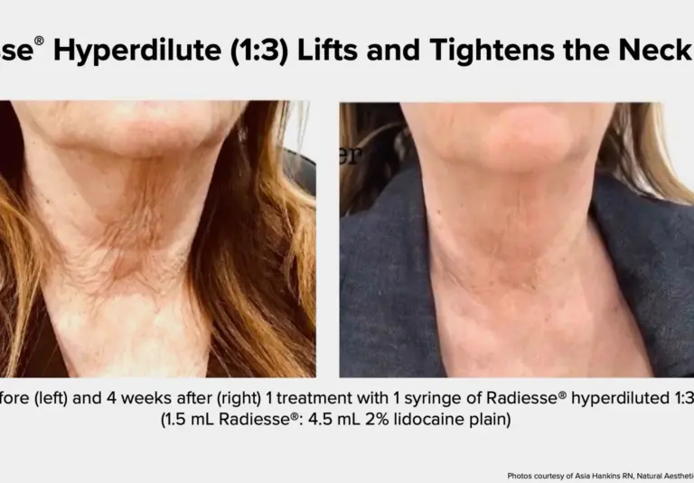 radiuses neck