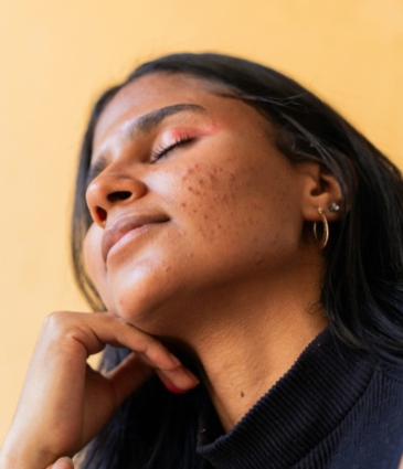 Acne Conditions Feat Rr