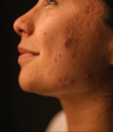 Acne Scarring Conditions Feat Rr