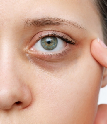 Dark Circles Conditions Feat Rr