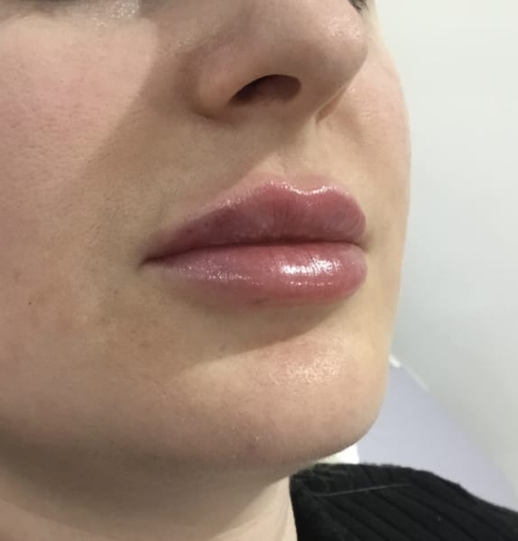 After Lip filler