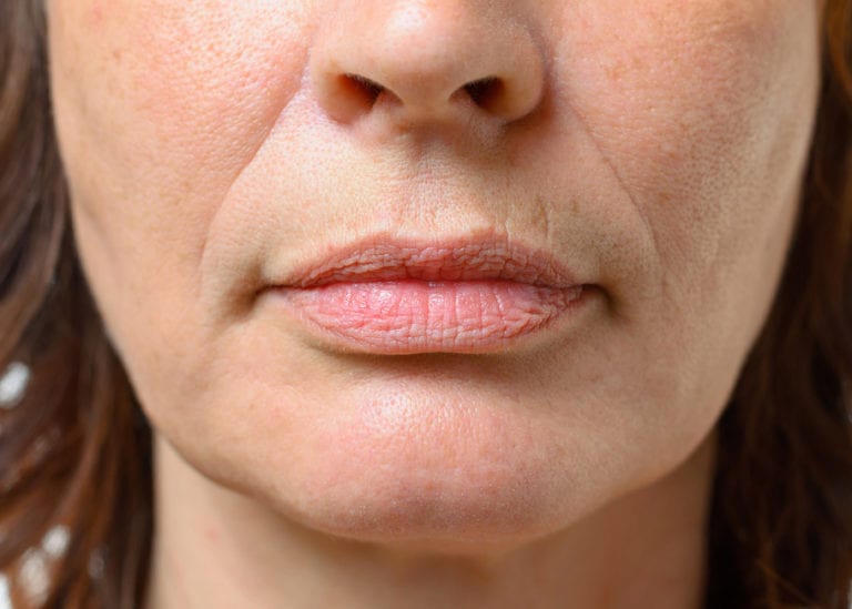 Facial Volume Loss Leeds Facial Volumen Loss Garforth Fillers Leeds