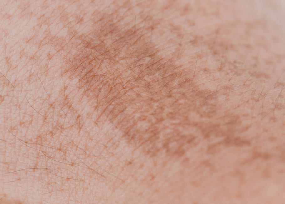 Hyperpigmentation Arms