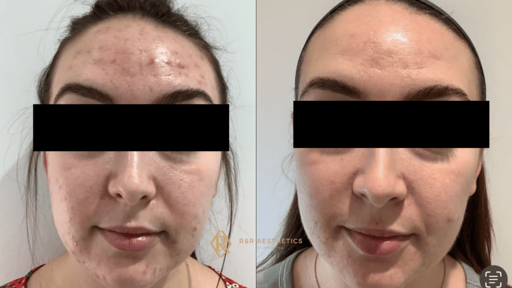Acne treatment in Leeds