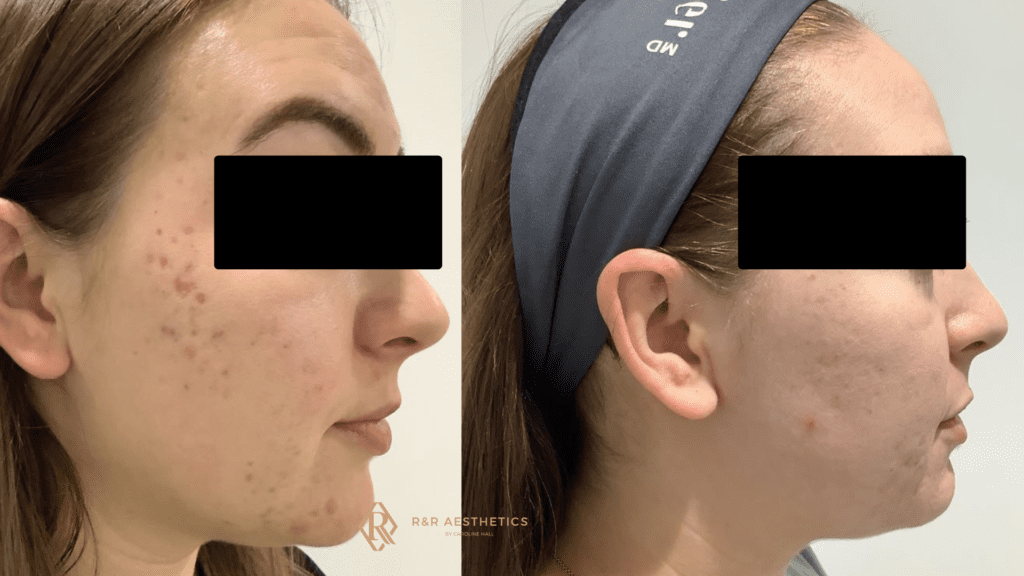 acne scars before and after