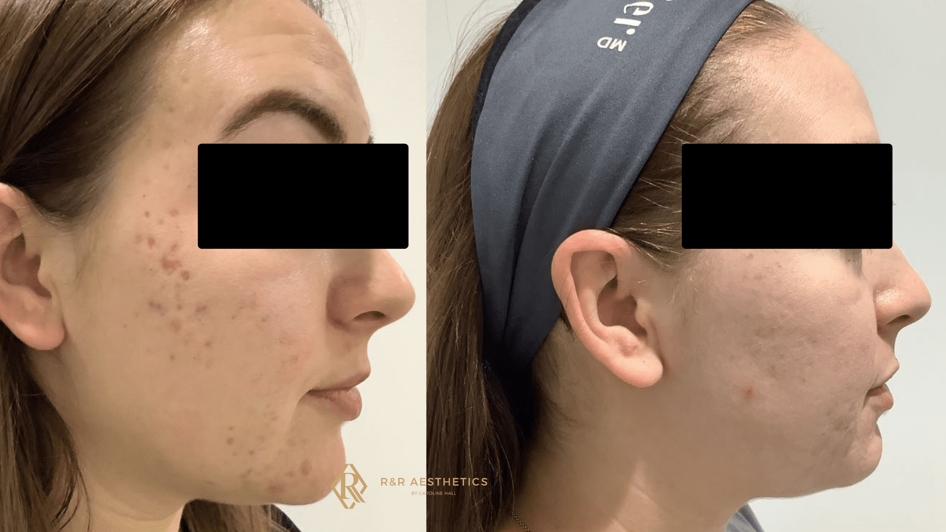 Acne Scars Treatment Leeds Acne Scar Treatment Acne Scars Leeds