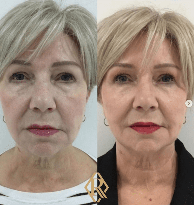 Dermal filler Leeds