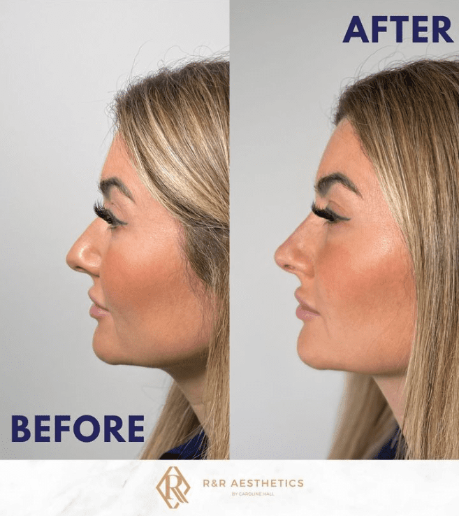 Non surgical Rhinoplasty Garforth Leeds