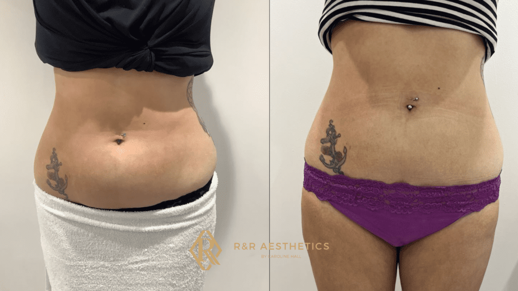 Fat freezing before and after Leeds