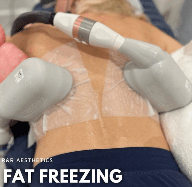 Fat freezing pads applied to patient Leeds