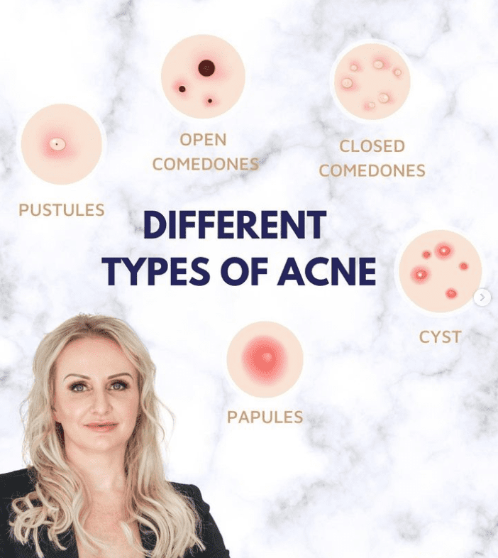 Acne Awareness month