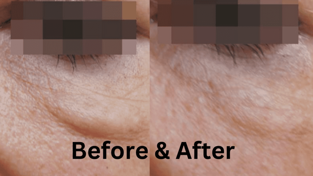 non surgical eye lift endybleph leeds