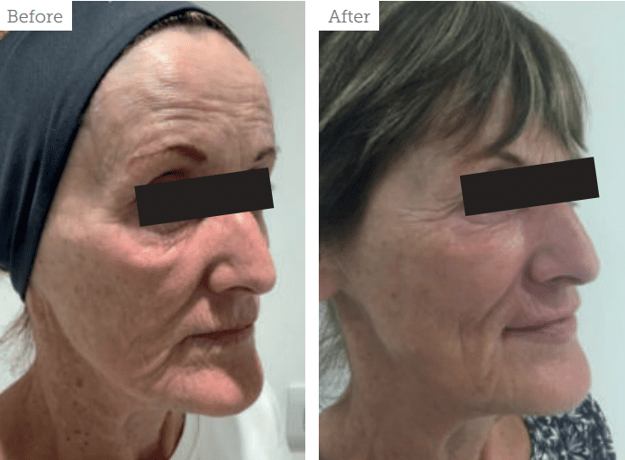 Combination approach to anti ageing aesthetics