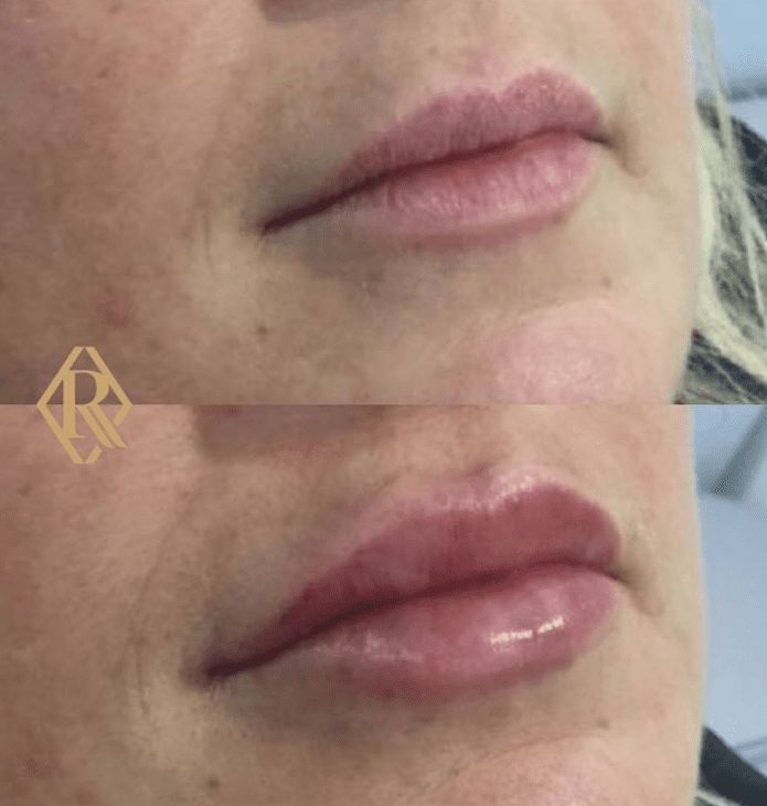 before & after lip filler garforth
