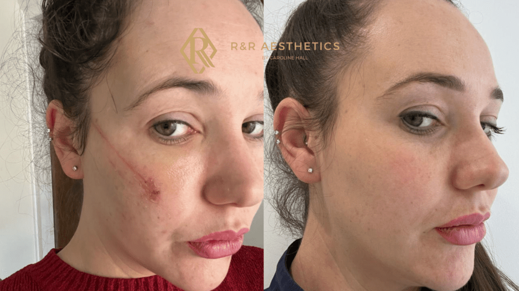 before and after scar treatment