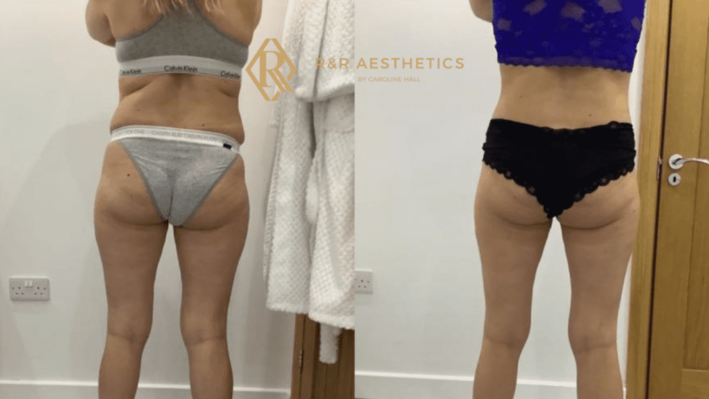 fat freezing before and after