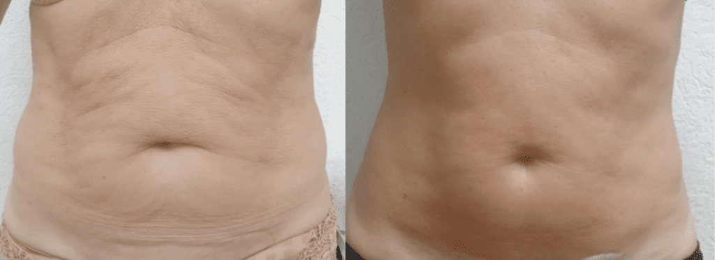 before and after endymed body contouring