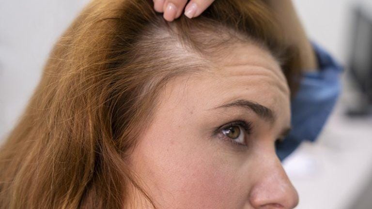Hair loss