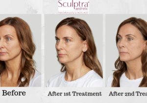 Introducing Sculptra at R&R Aesthetics