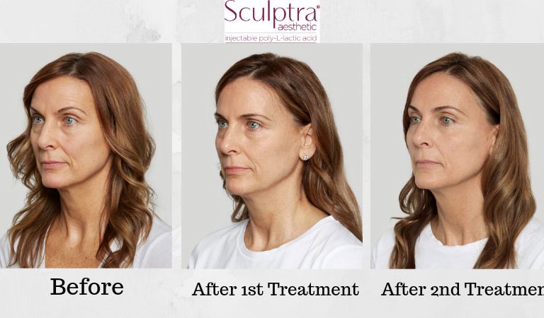 sculptra_treatment-image